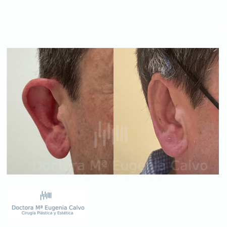 otoplastia