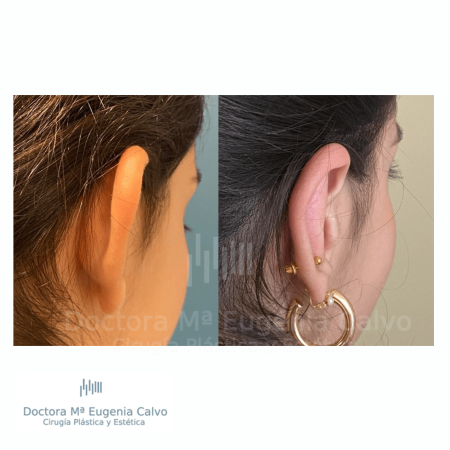otoplastia