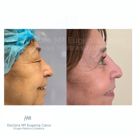 blefaroplastia fotos