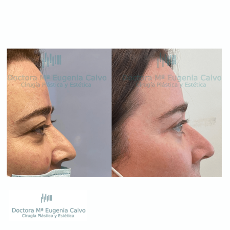 blefaroplastia fotos