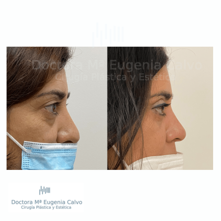 blefaroplastia fotos