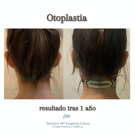otoplastia cirugía orejas
