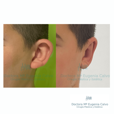 otoplastia cirugia orejas