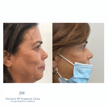 blefaroplastia fotos
