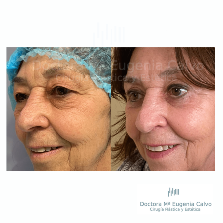 blefaroplastia fotos