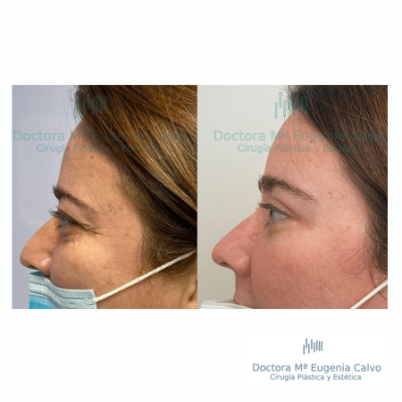 blefaroplastia fotos