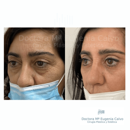 blefaroplastia fotos