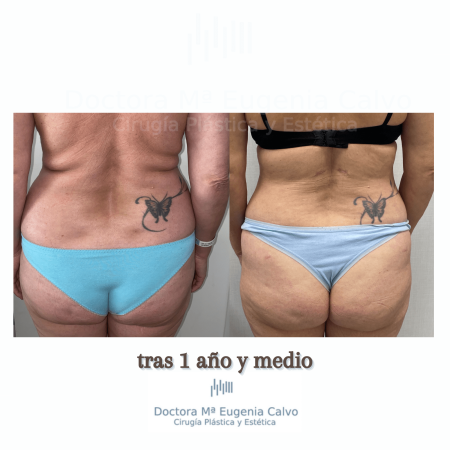 abdominoplastia y liposucción sevilla caso real