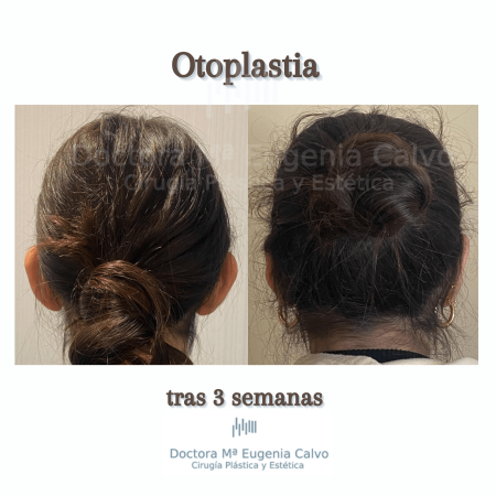 otoplastia