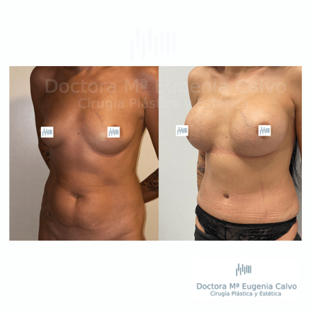 abdominoplastia y aumento mamario sevilla caso real