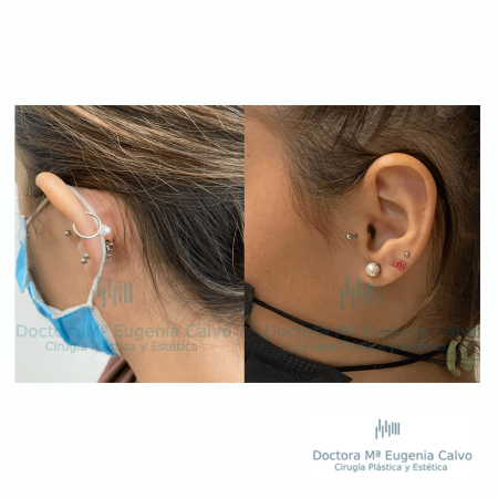 otoplastia cirugía orejas