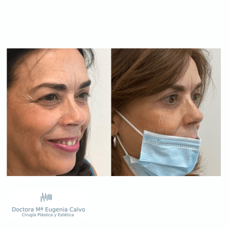 blefaroplastia fotos