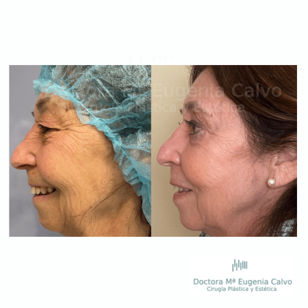 blefaroplastia fotos