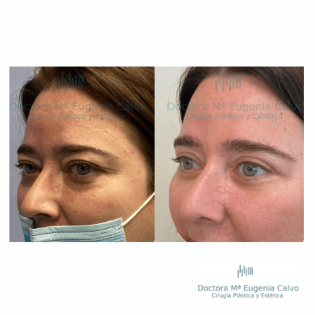 blefaroplastia fotos