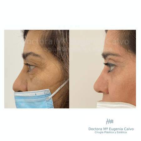 blefaroplastia fotos