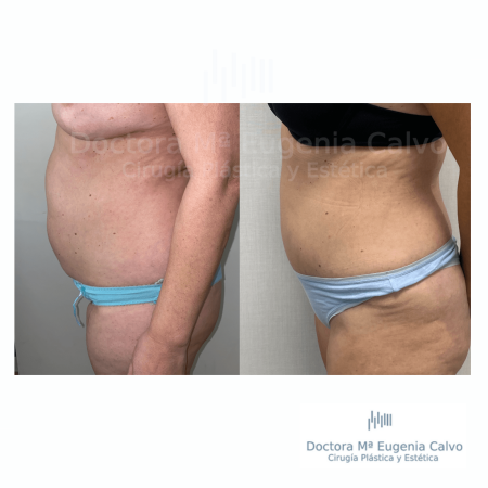 abdominoplastia y liposucción sevilla caso real