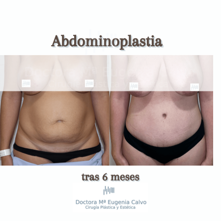 abdominoplastia sevilla