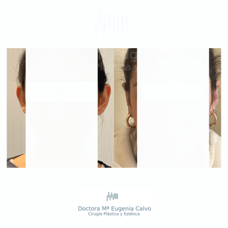 otoplastia