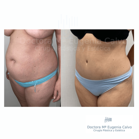abdominoplastia y liposucción sevilla caso real