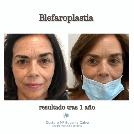 blefaroplastia fotos