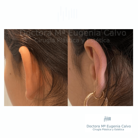 otoplastia