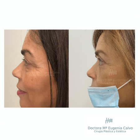 blefaroplastia fotos