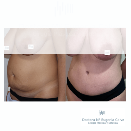 abdominoplastia sevilla
