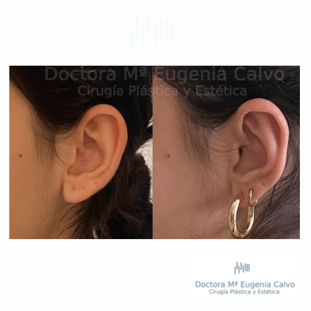 otoplastia