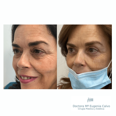 blefaroplastia fotos