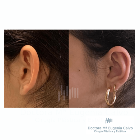otoplastia
