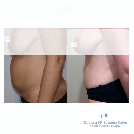 abdominoplastia sevilla