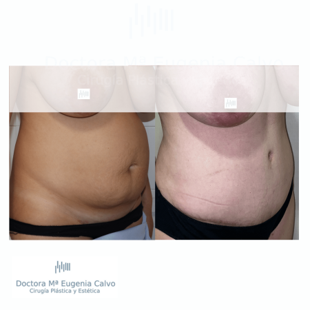 abdominoplastia sevilla