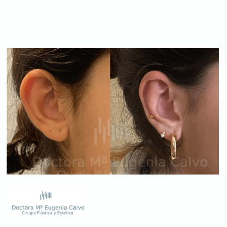 otoplastia