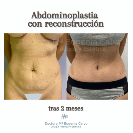 abdominoplastia sevilla caso real