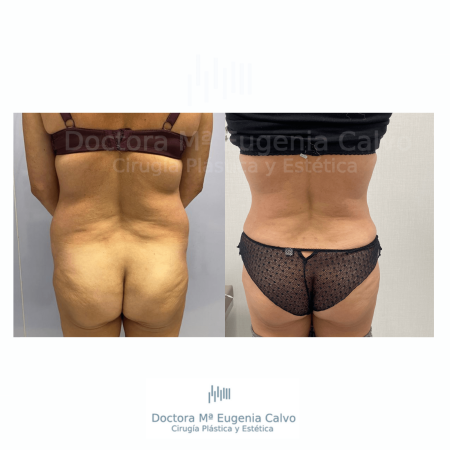 abdominoplastia y liposucción sevilla caso real