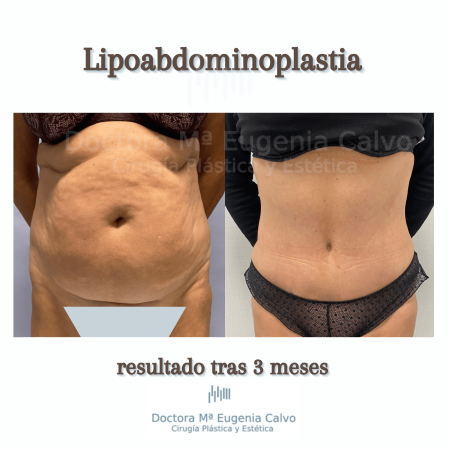 abdominoplastia y liposucción sevilla caso real