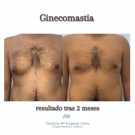 Ginecomastia foto