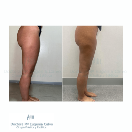 cirugía lipedema