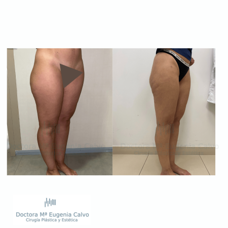Lipedema cirugía
