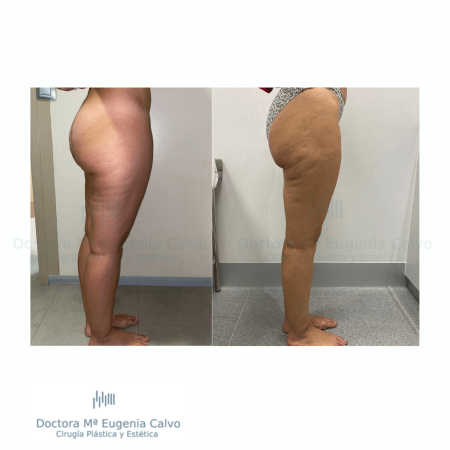 Lipedema cirugía