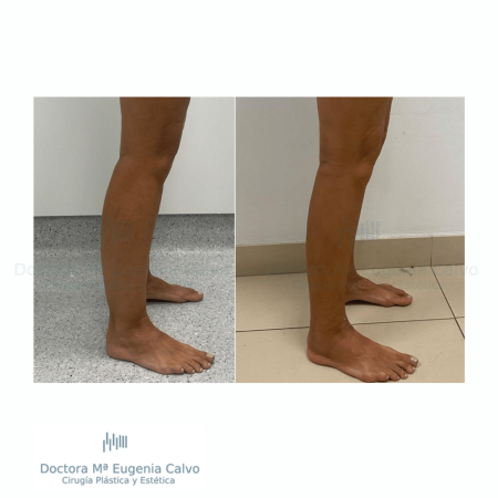Lipedema cirugia caso real