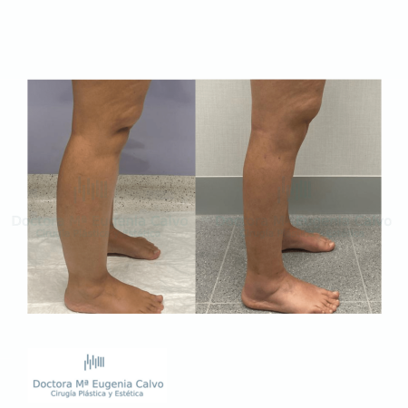lipedema caso real