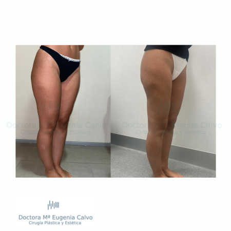 cirugía lipedema