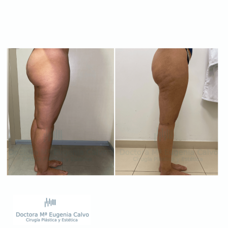 Lipedema cirugía