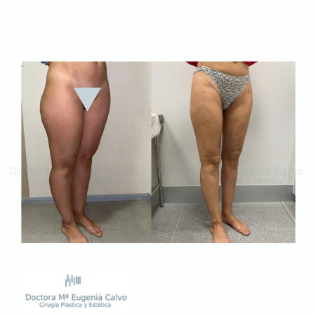 Lipedema cirugía