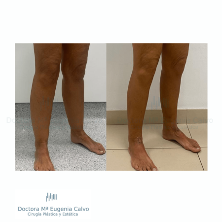 Lipedema cirugia caso real