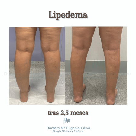 lipedema caso real