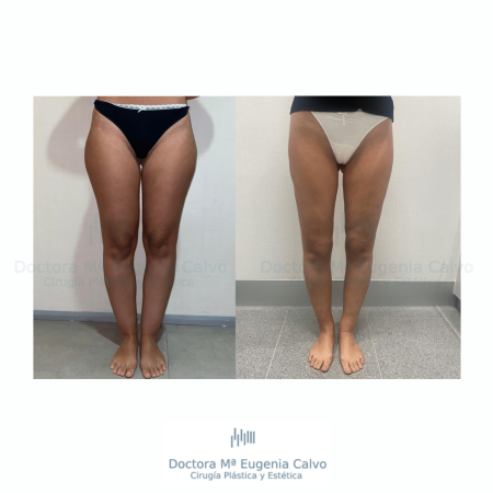 cirugía lipedema