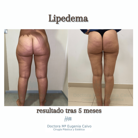 Lipedema cirugía
