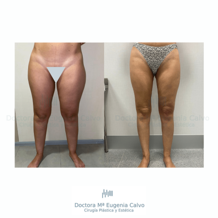 Lipedema cirugía